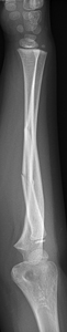 Figure 2_1189342_Greenstick fracture_lateral.jpg